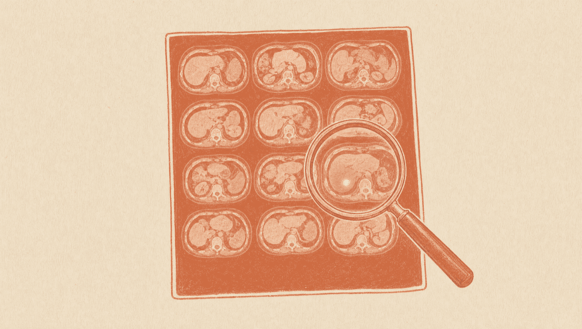 Avid Does Not Mean Cancer: How to Read a PET/CT Scan Report Without Panicking