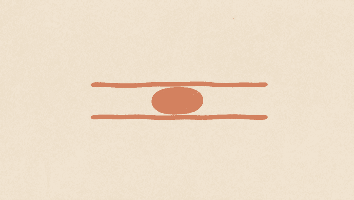 A Stomach Wall Tumor That Is Not an Ulcer: Reading a GIST