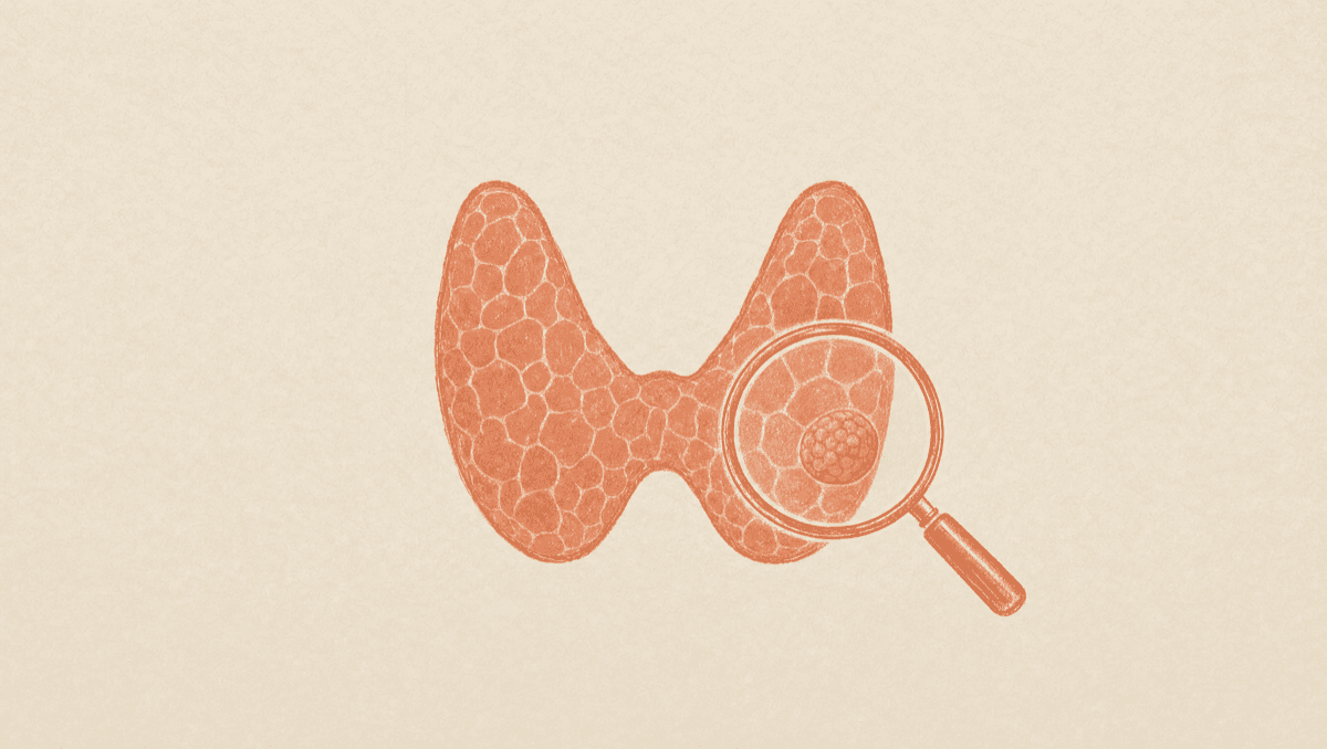 A Normal TSH Can Hide Hashimoto's: Why Thyroid Antibodies Get Skipped and What to Ask For